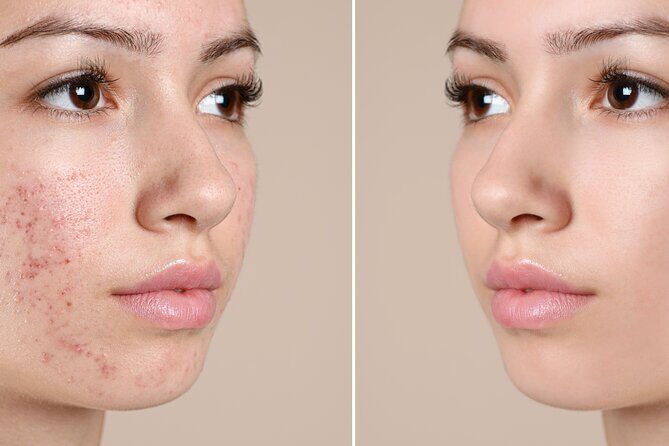 Skin Glo Package w/microderm/LED- For 2 with Appetizers and Wine - Who Should Consider This Experience?